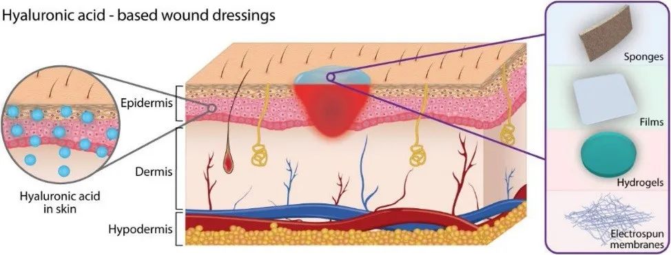 水凝胶在皮肤创面修复中的应用,图片,水凝胶,疤痕修复,皮肤损伤,瘢痕组织,巨噬细胞,第1张